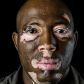 1- vitiligo -2R6A0303.jpg